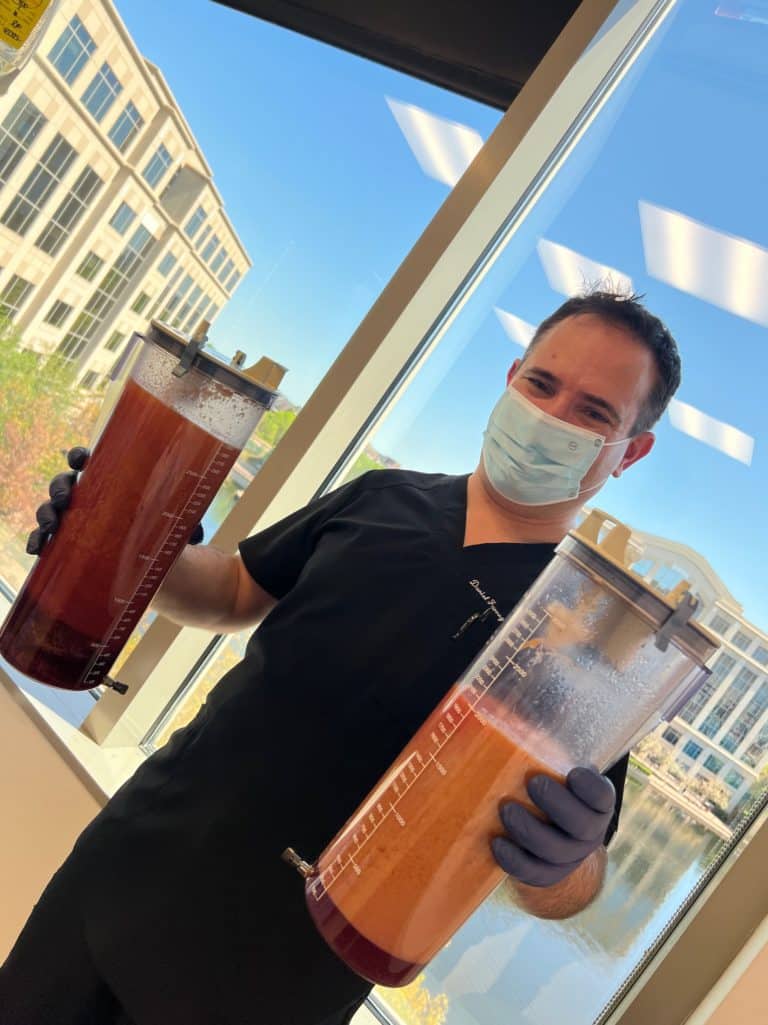 Canisters with 5 liters of fat from liposuction