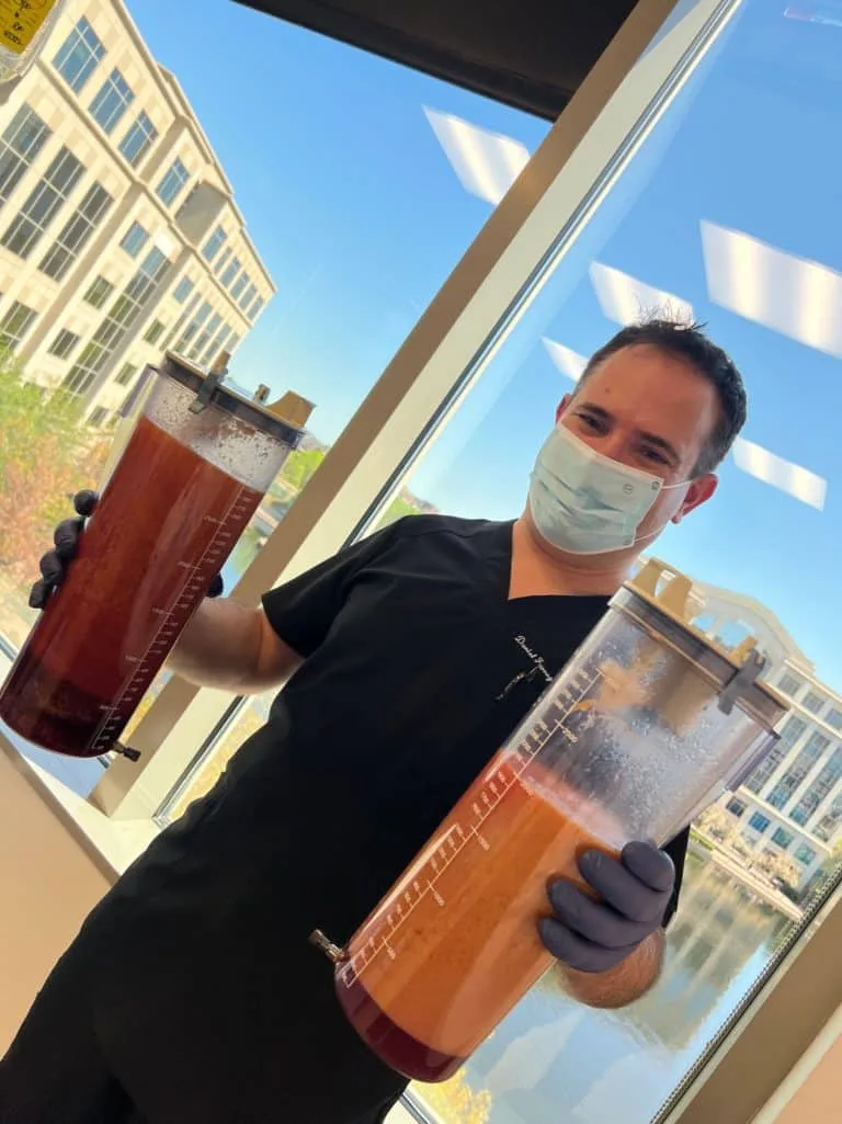 Canisters with 5 liters of fat from liposuction