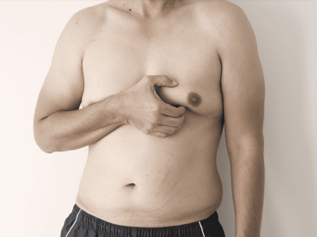 Gynecomastia in a Male