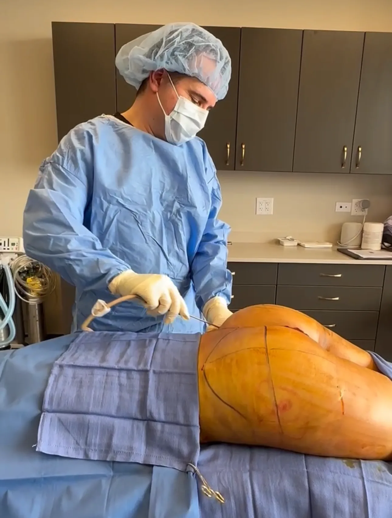 Awake_BBL_BodyLuxe_Chicago_Plastic_Surgeon
