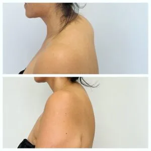 Buffalo hump removal by FormSculpt liposuction in Chicago at BodyLuxe - Before and After Result