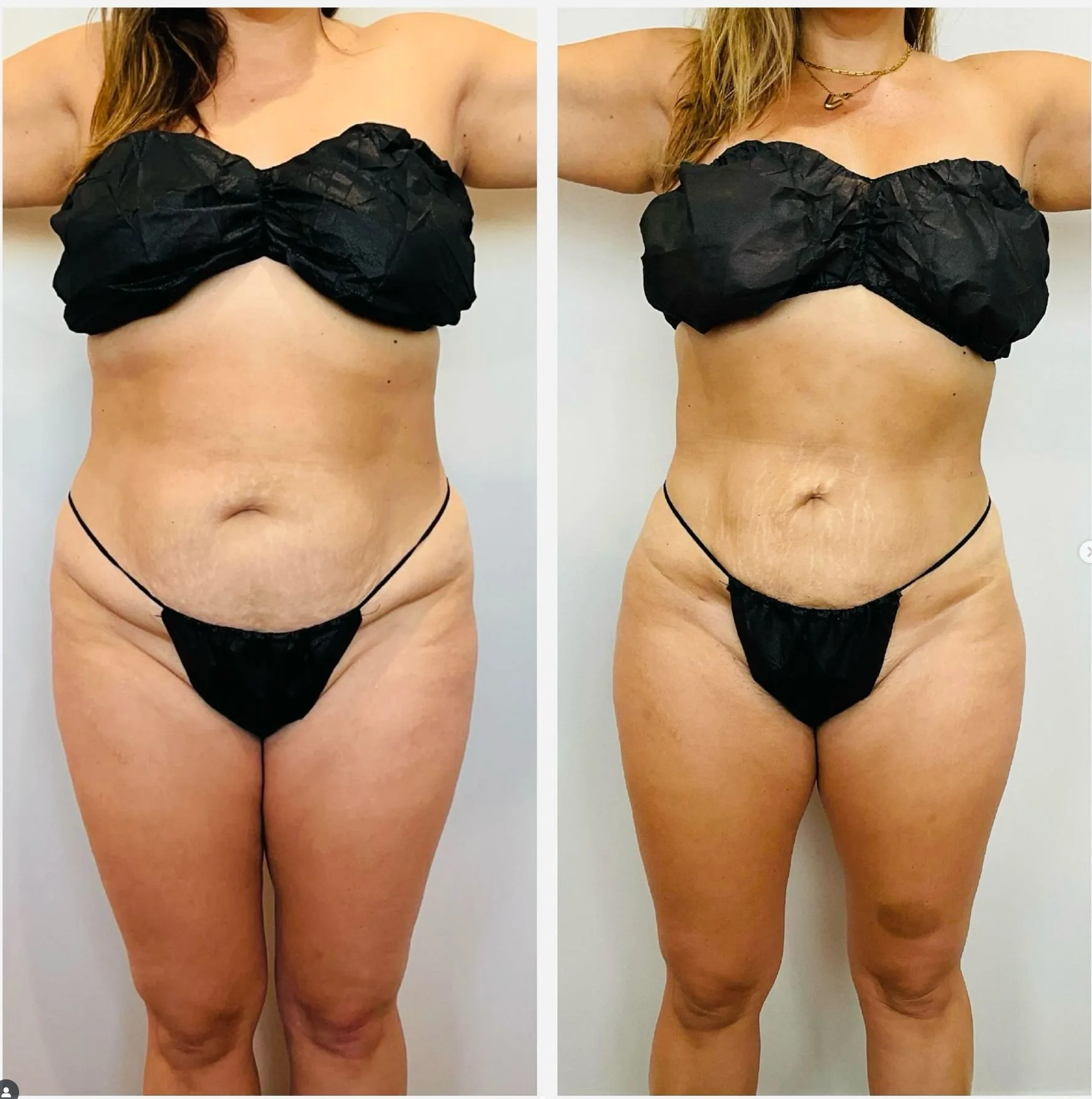 Front-view before-and-after collage of an abdomen following Awake Fat Removal.