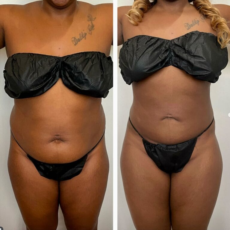 Awake liposuction before and after, front view of abdominal contouring