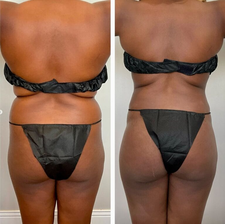 Awake liposuction before and after, back view of torso contouring