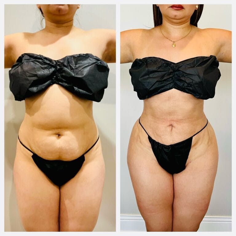 Combined liposuction and BBL, front: before (left) and after (right). Brazilian butt lift with liposuction before and after, front view of donor-area contouring