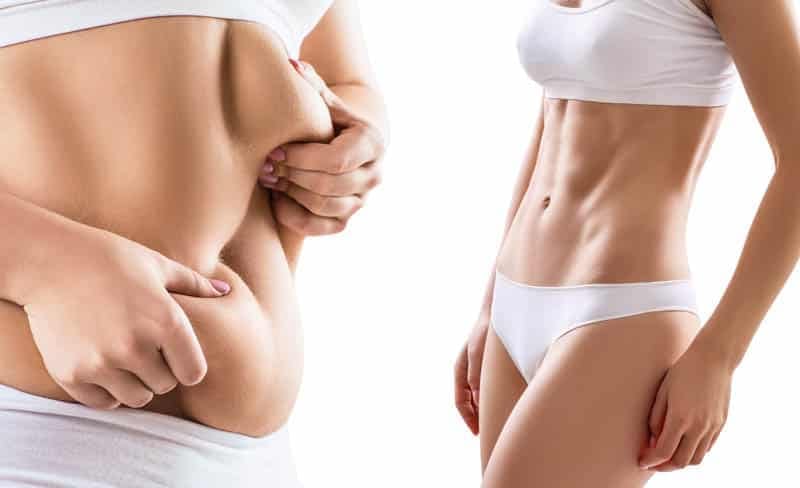 Can You Gain Back Fat After Liposuction? Understanding the Long-Term Impact