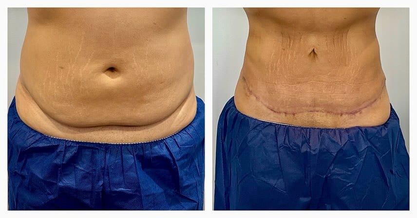 Front view: before (left) and after (right). Mini tummy tuck before and after, front view of the abdomen