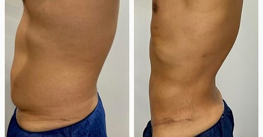 Side view: before (left) and after (right). Mini tummy tuck before and after, side view of the abdomen