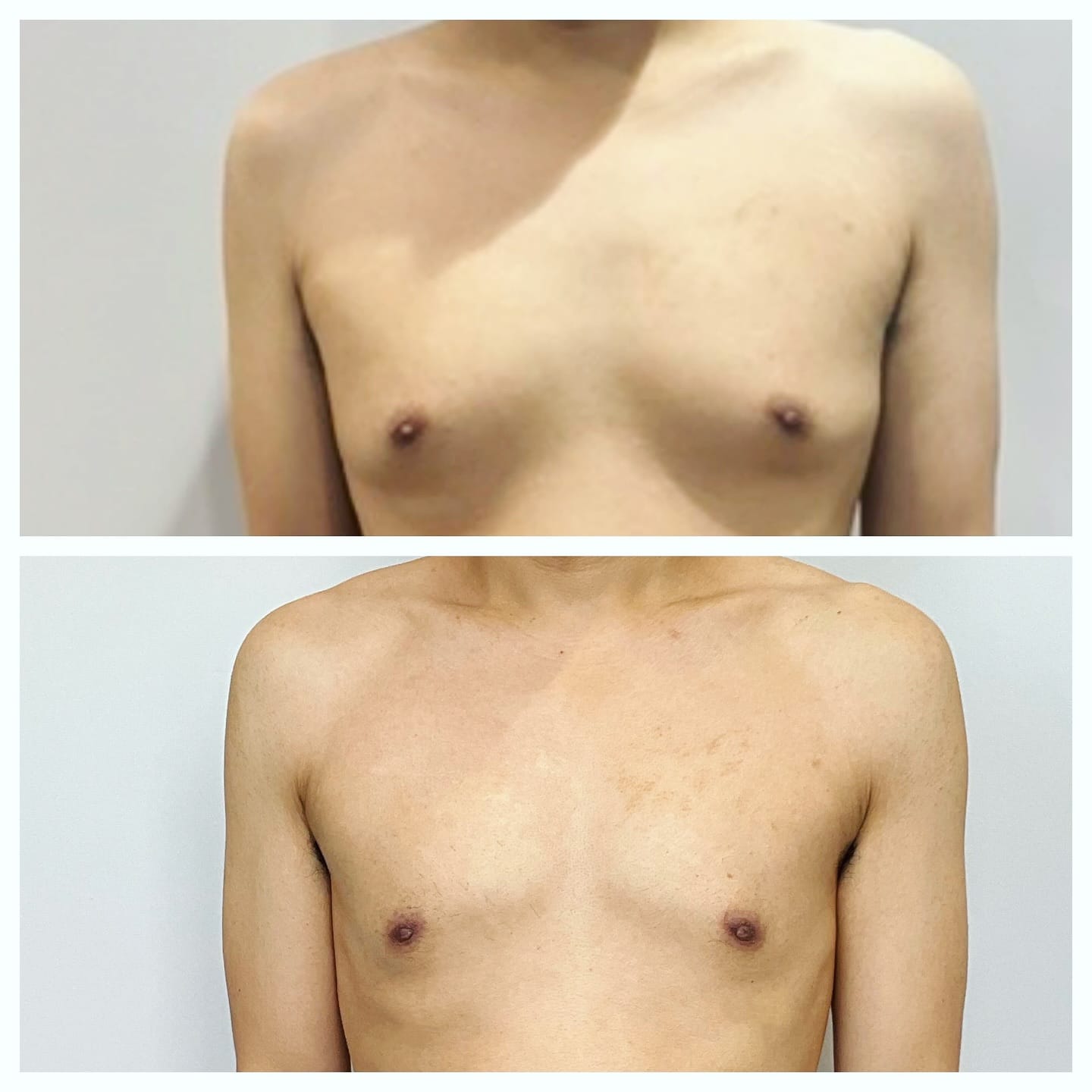 Gynecomastia Surgery in Chicago 1 Male chest contouring before and after, front view