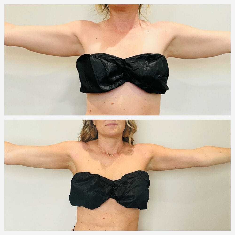Arms extended: before (top) and after (bottom). Arm liposuction before and after, front view with arms extended