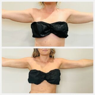 Arm liposuction before and after, front view of the upper arms with arms extended