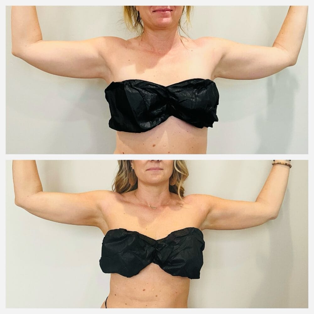 Arms raised: before (top) and after (bottom). Arm liposuction before and after, front view with arms raised
