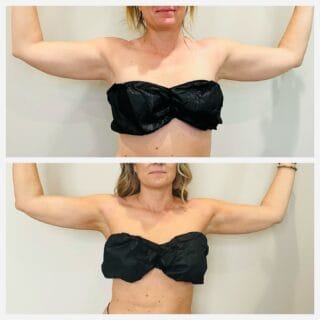 Arm liposuction before and after, front view of the upper arms with arms raised