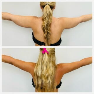Arm liposuction before and after, back view of the upper arms with arms extended