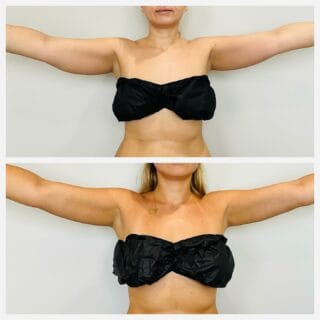 Arm liposuction before and after, front view of the upper arms with arms extended