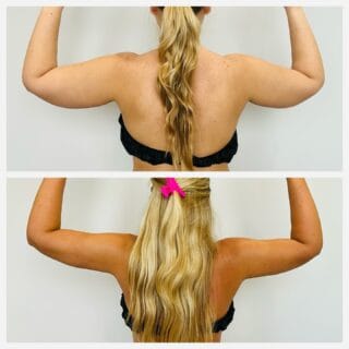 Arm liposuction before and after, back view of the upper arms with arms raised