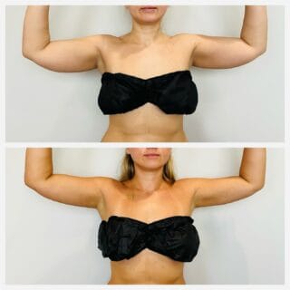 Arm liposuction before and after, front view of the upper arms with arms raised