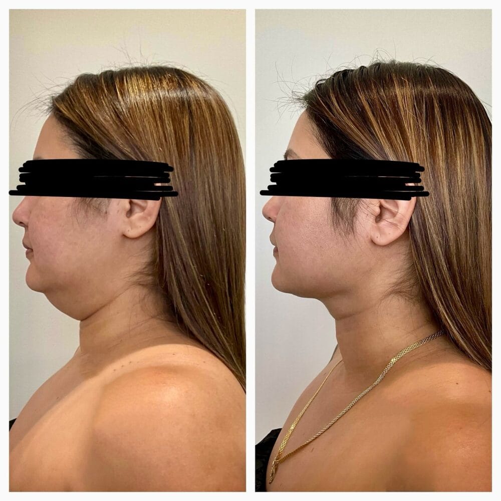 BodyLuxe Chin and Jawline before and after, lateral view