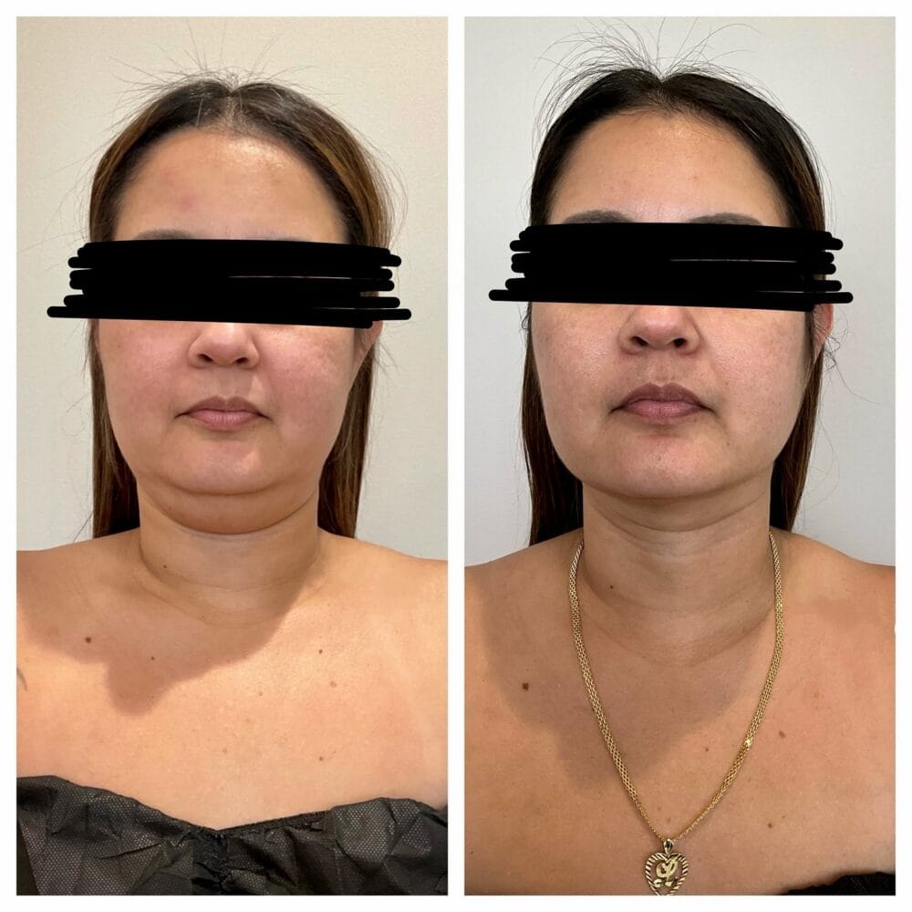 BodyLuxe Chin and Jawline before and after, front view
