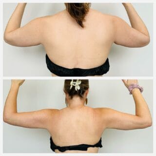 Arm liposuction before and after, back view of the upper arms with arms raised