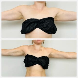Arm liposuction before and after, front view of the upper arms with arms extended