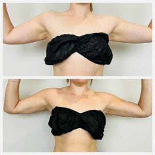 Arm liposuction before and after, front view of the upper arms with arms raised