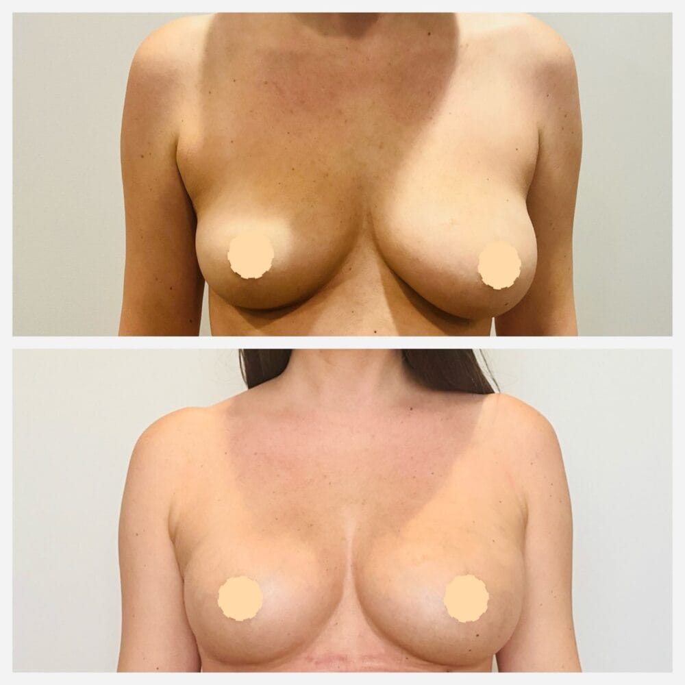 Before and after front view after FormSculpt