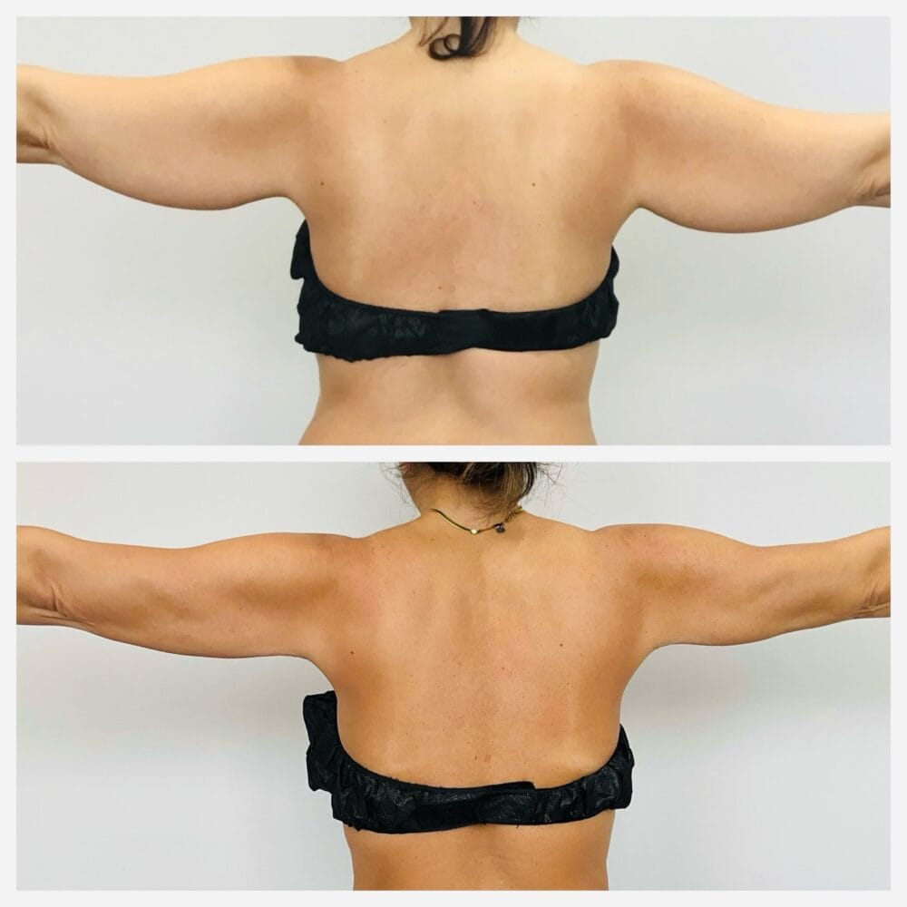 Arm liposuction before and after, back view of the upper arms with arms extended