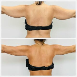 Arm liposuction before and after, back view of the upper arms with arms extended