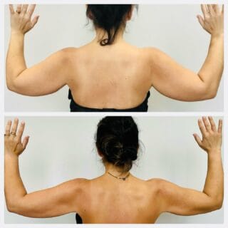 Arm liposuction before and after, back view of the upper arms with arms raised