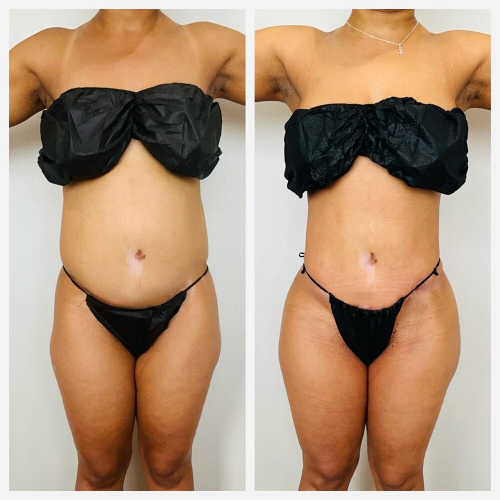 Before and after side view