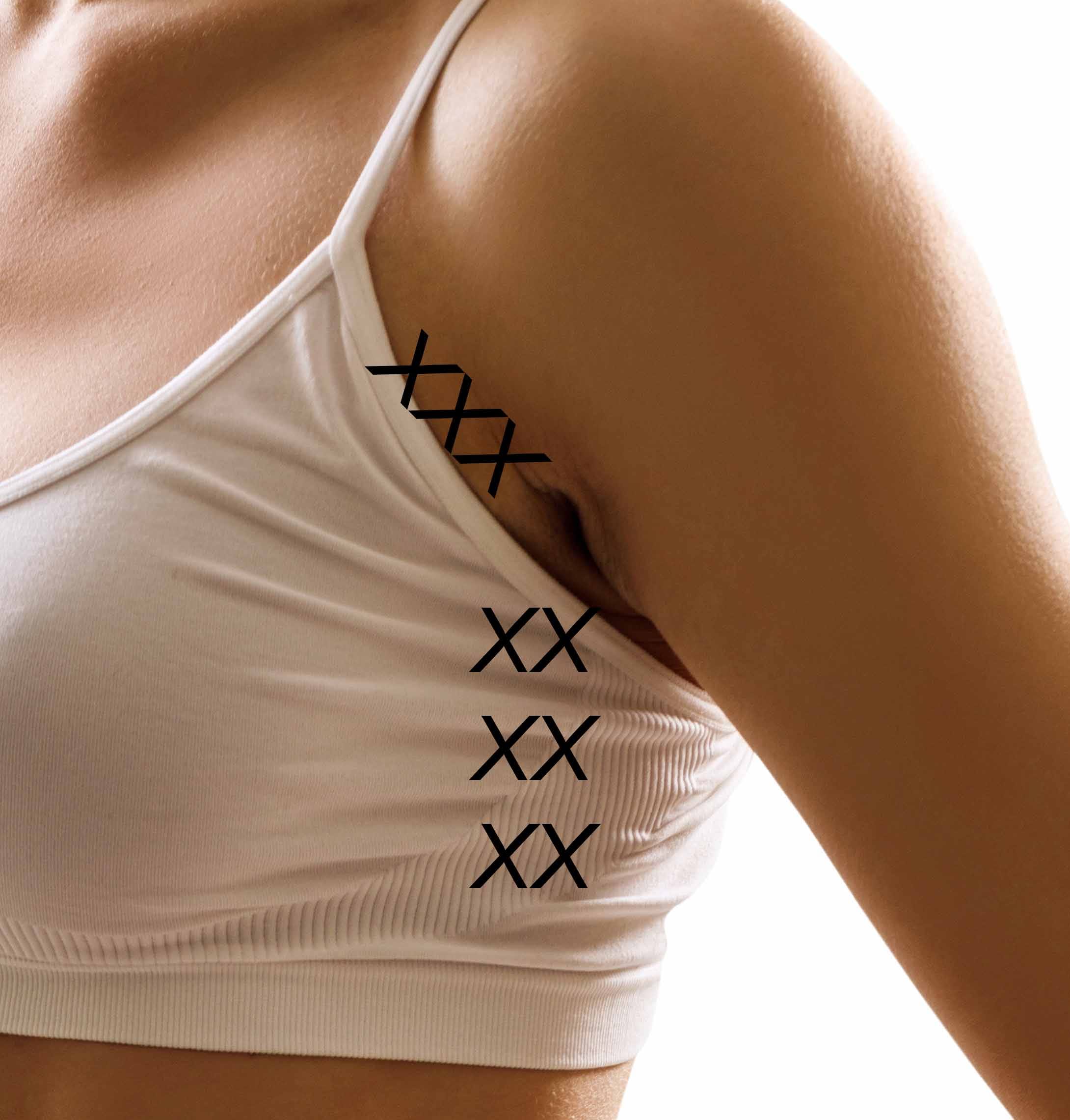 Surgical Procedures in Chicago 8 Armpit and front bra roll area