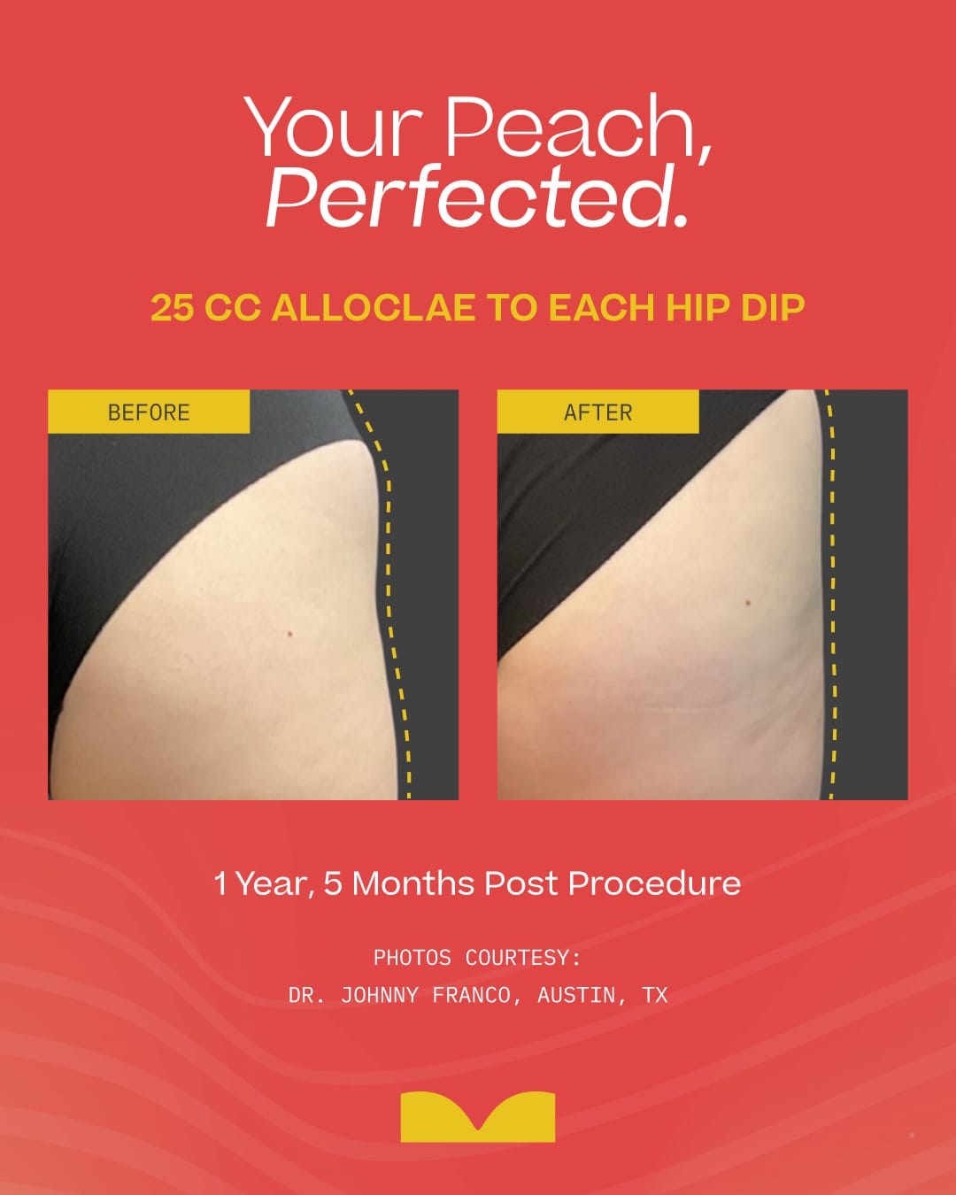 Official alloClae Instagram hip-dip before-and-after (25 cc per hip dip); patient photos courtesy Dr. Johnny Franco via @alloclae