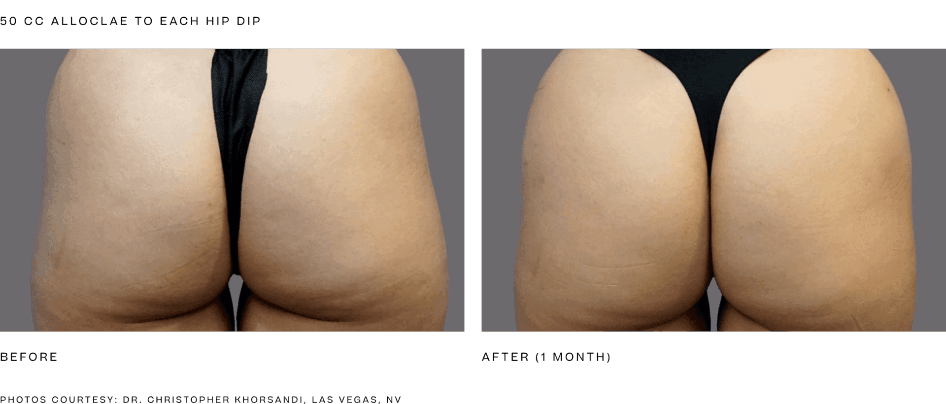 Manufacturer educational AlloClae lower-body contour before-and-after collage from alloClae.com