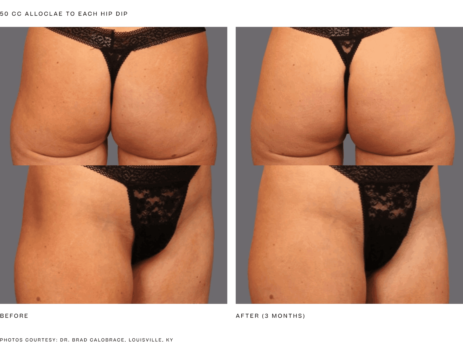 Manufacturer educational AlloClae gluteal and hip contour before-and-after collage from alloClae.com