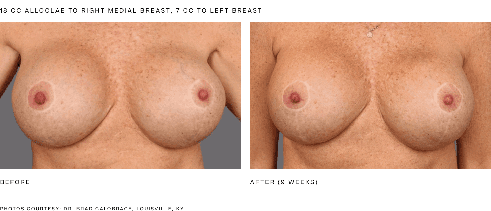 Manufacturer educational AlloClae breast contour before-and-after result from alloClae.com